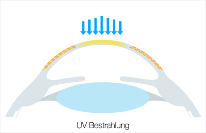 Crosslinking - CXL - Keratokonus - UV Bestrahlung