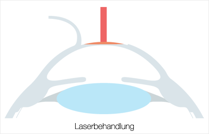 LASIK - Laserbehandlung