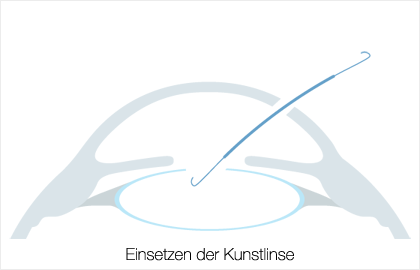 RLA - Refraktiver Linsenaustausch - Einsetzen der Kunstlinse